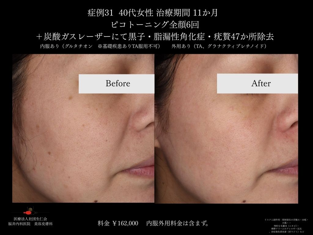 ピコレーザー症例_vol.31_003