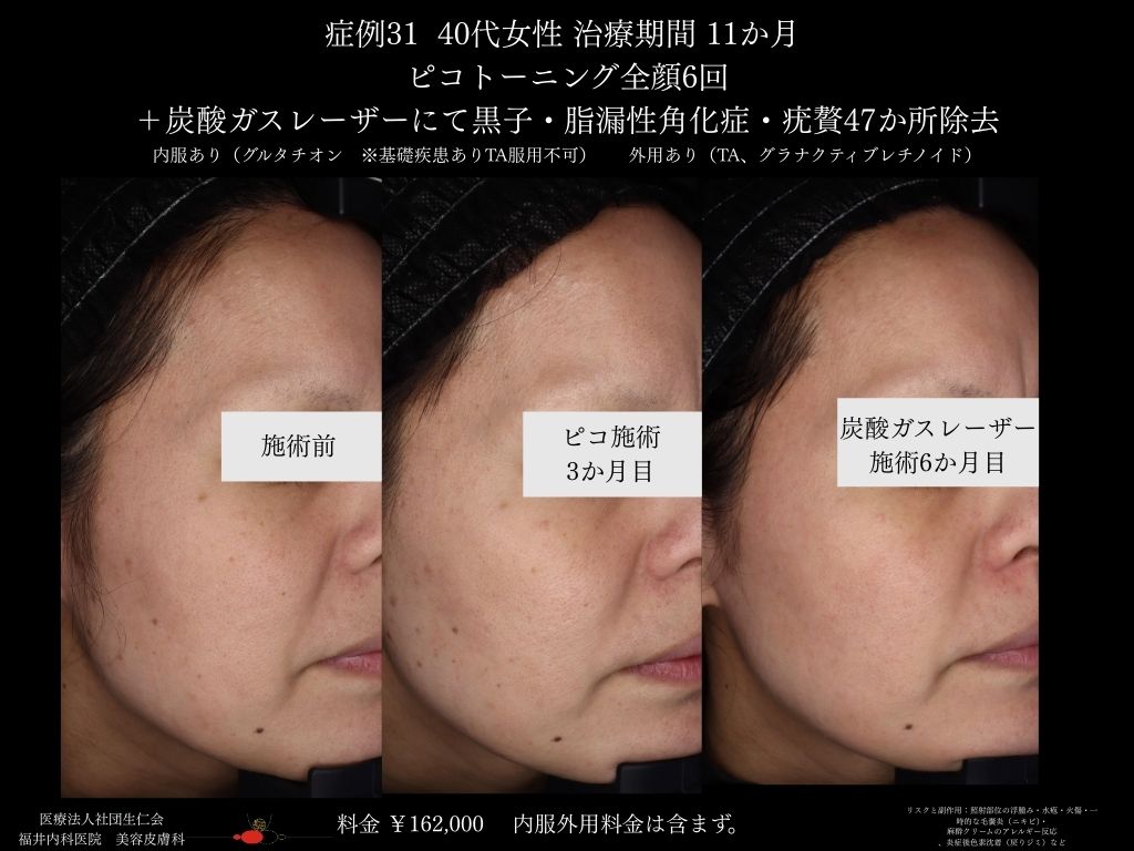 ピコレーザー症例_vol.31_004