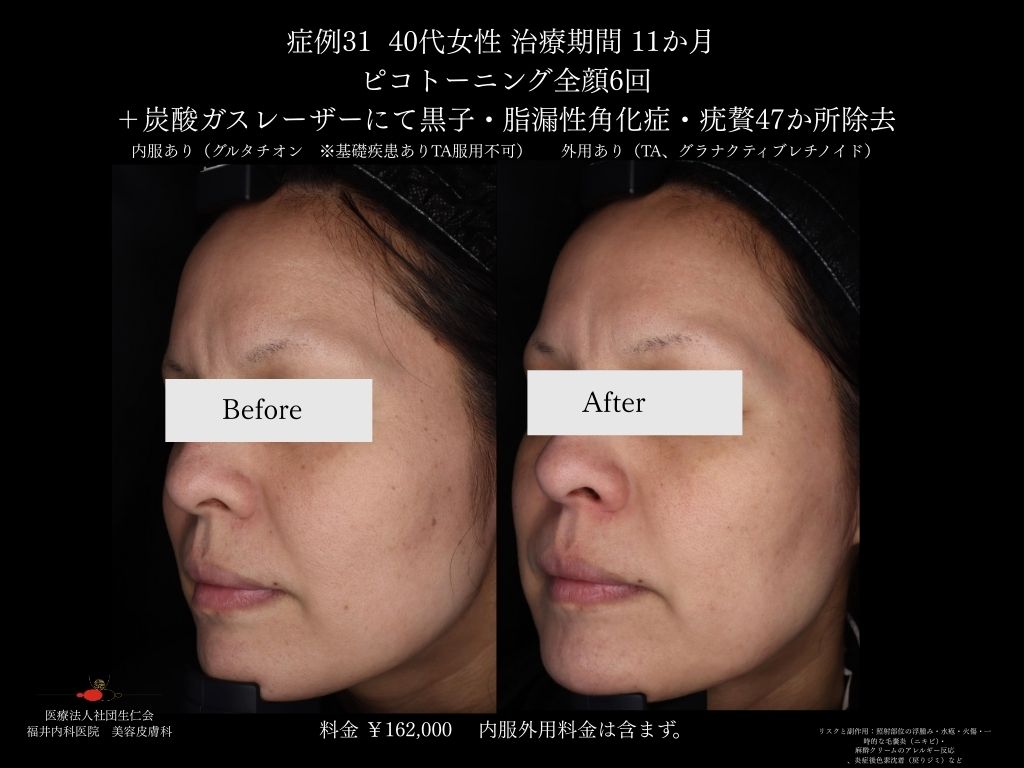 ピコレーザー症例_vol.31_005