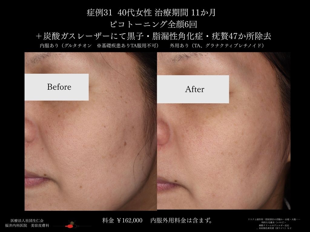 ピコレーザー症例_vol.31_006