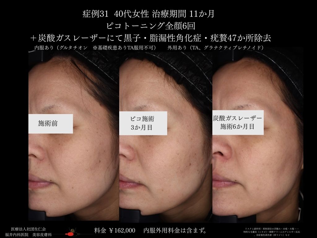 ピコレーザー症例_vol.31_007