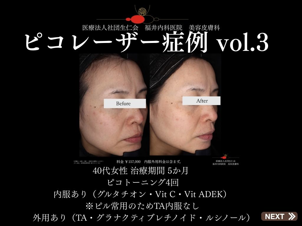 ピコレーザー症例_vol.3_001