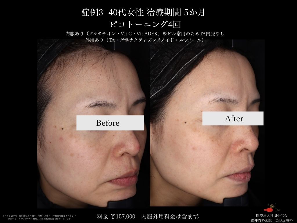 ピコレーザー症例_vol.3_002