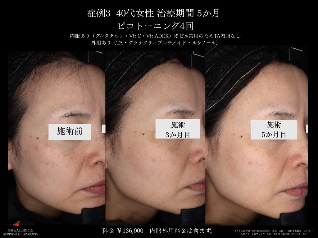 ピコレーザー症例_vol.3_003