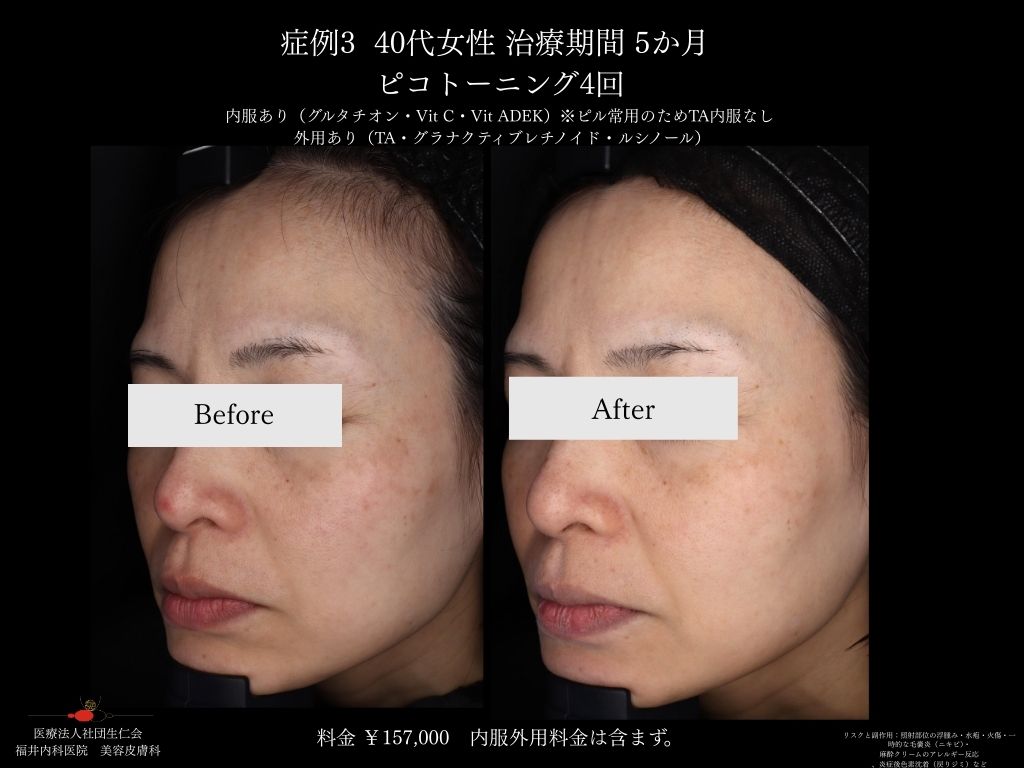 ピコレーザー症例_vol.3_004