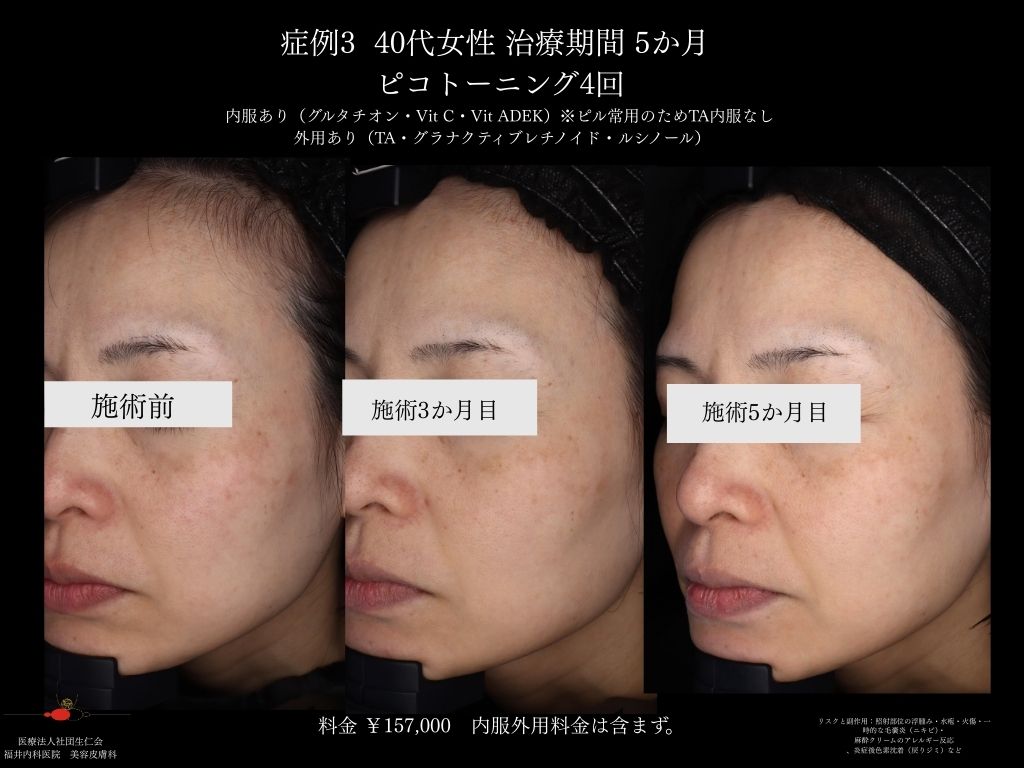 ピコレーザー症例_vol.3_005