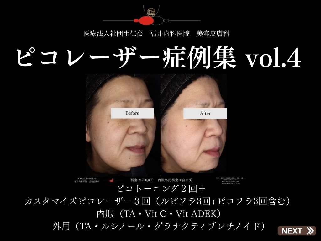 ピコレーザー症例_vol.4_001
