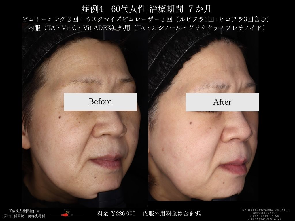 ピコレーザー症例_vol.4_002