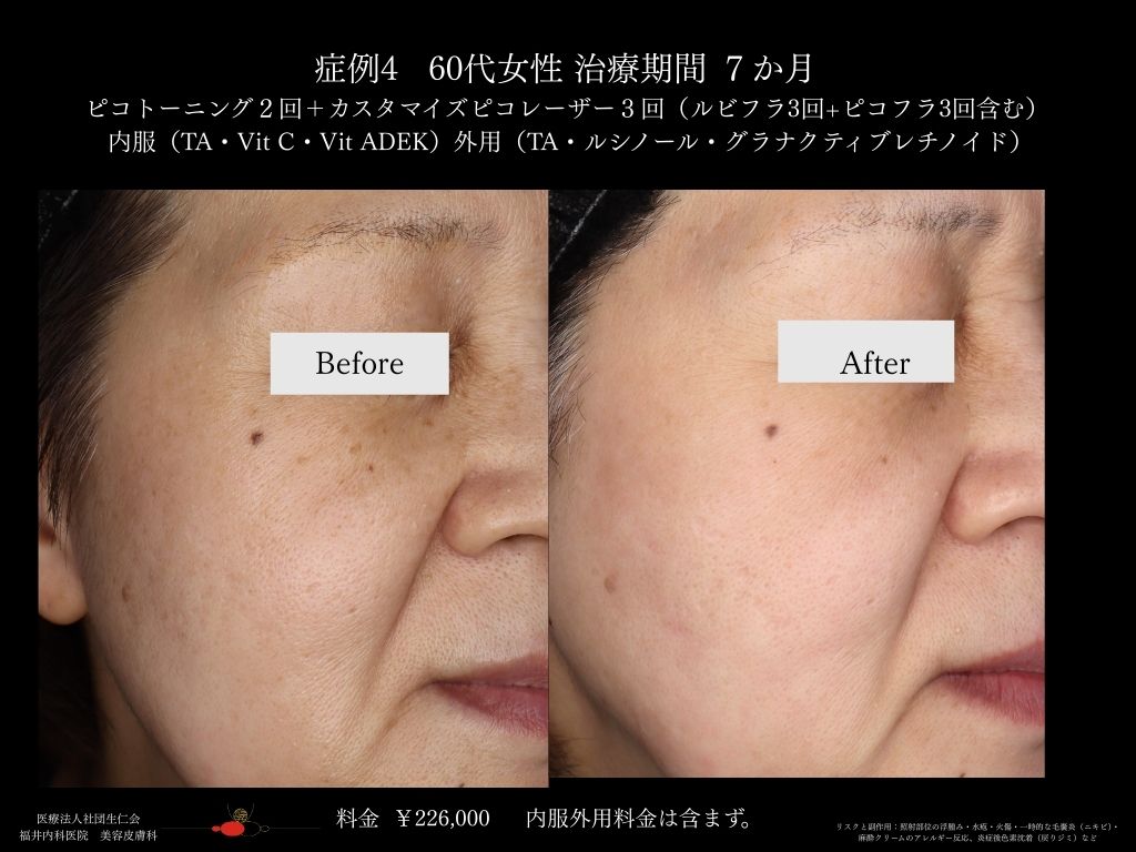 ピコレーザー症例_vol.4_003