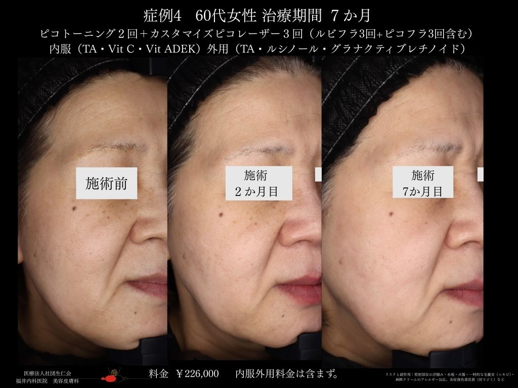 ピコレーザー症例_vol.4_004