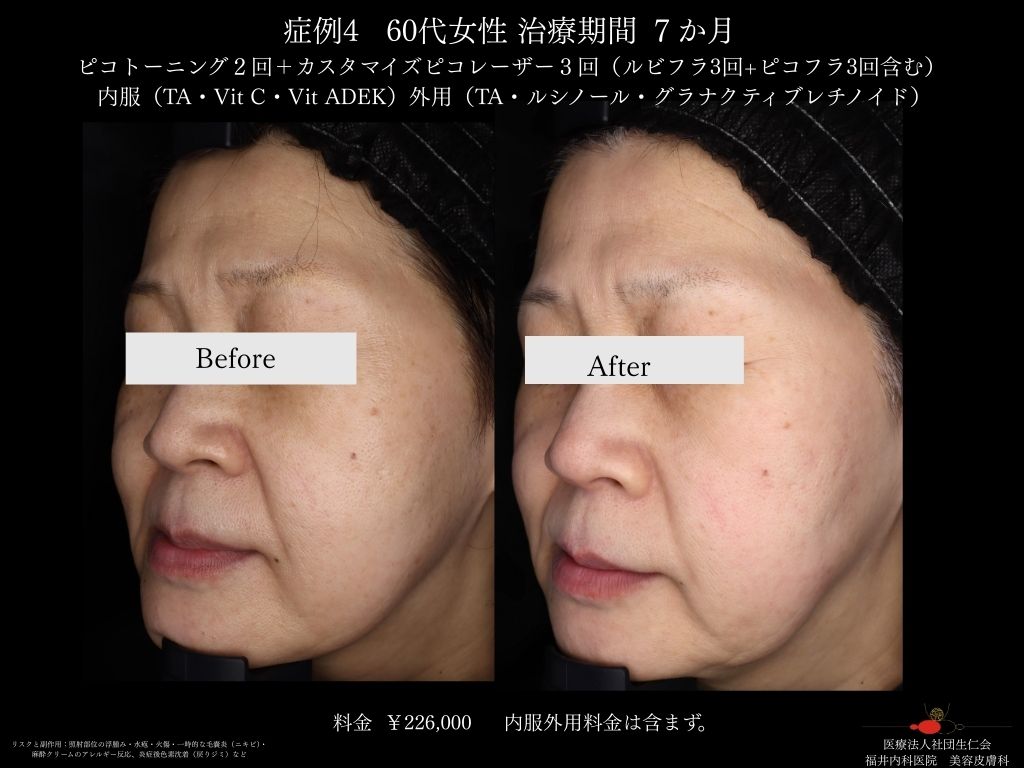 ピコレーザー症例_vol.4_005