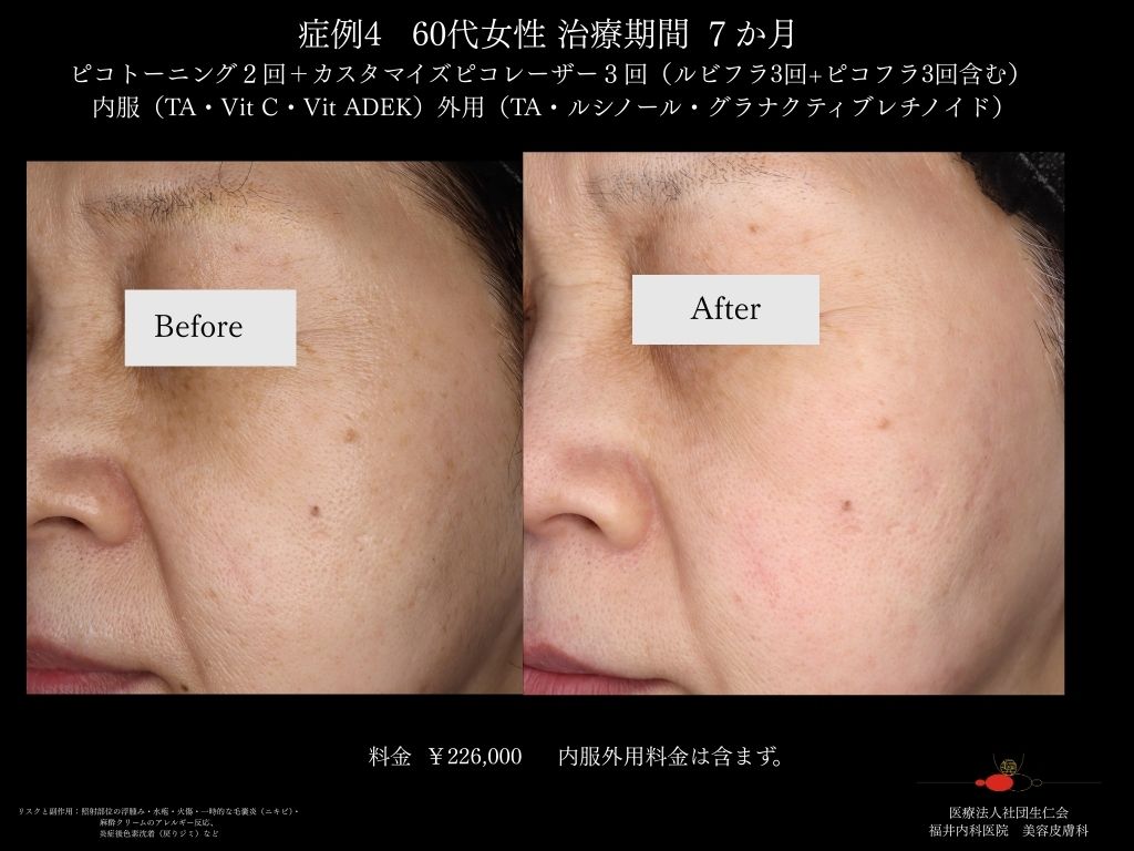 ピコレーザー症例_vol.4_006