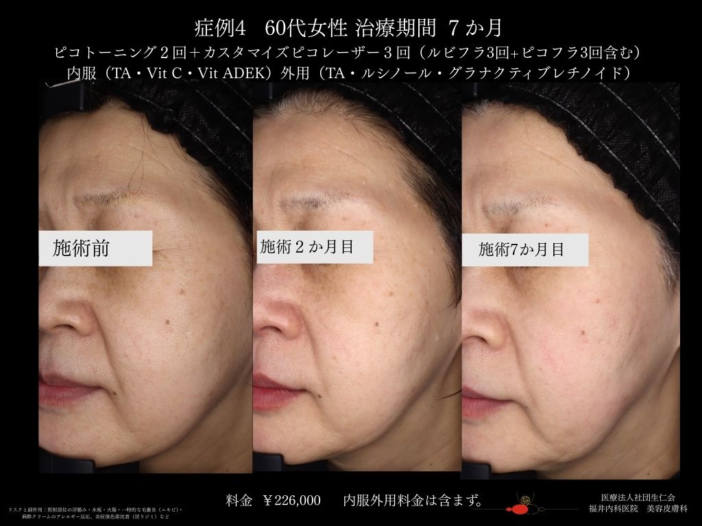 ピコレーザー症例_vol.4_007