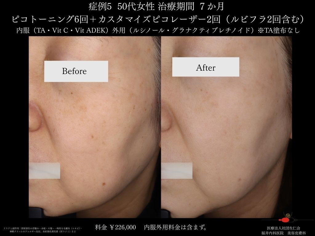 ピコレーザー症例_vol.5_002