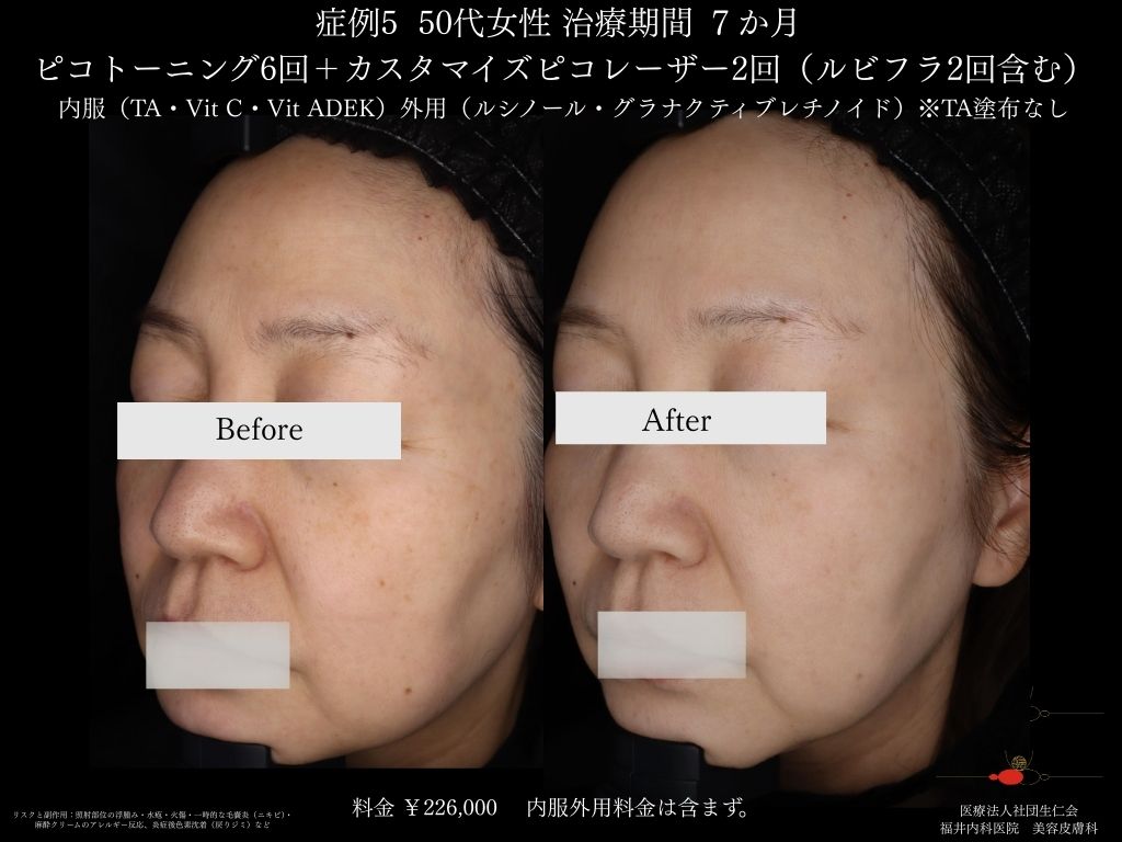 ピコレーザー症例_vol.5_003