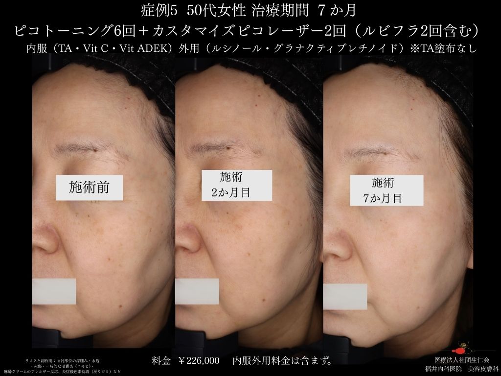 ピコレーザー症例_vol.5_004