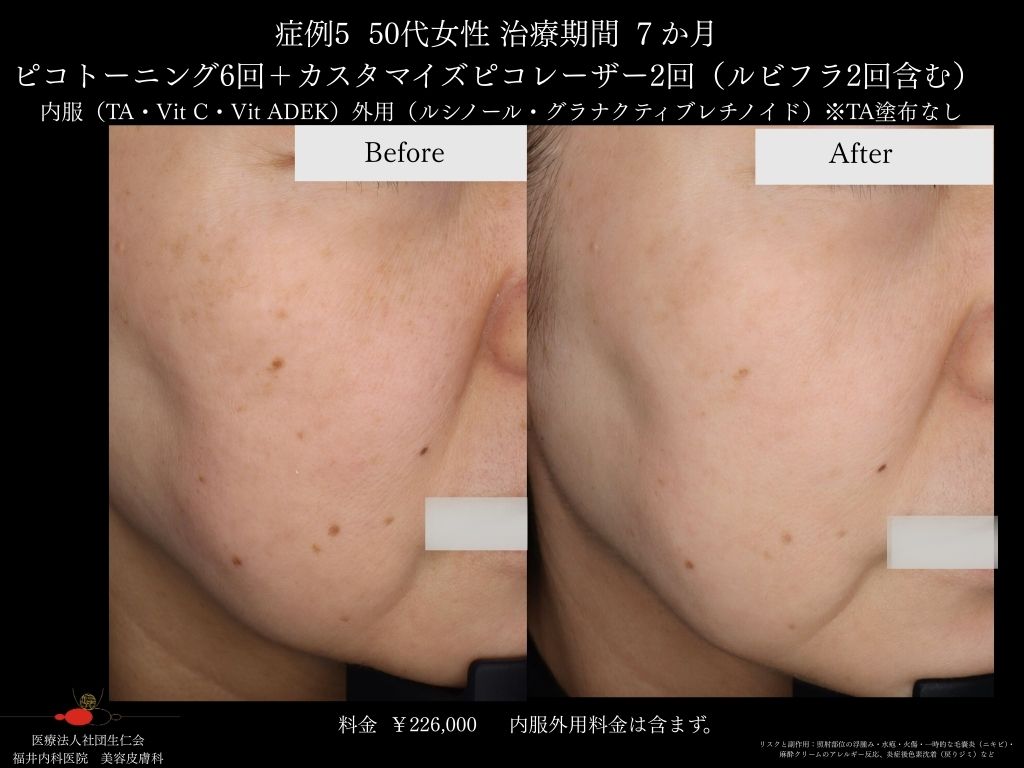 ピコレーザー症例_vol.5_005