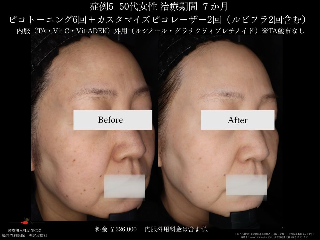 ピコレーザー症例_vol.5_006