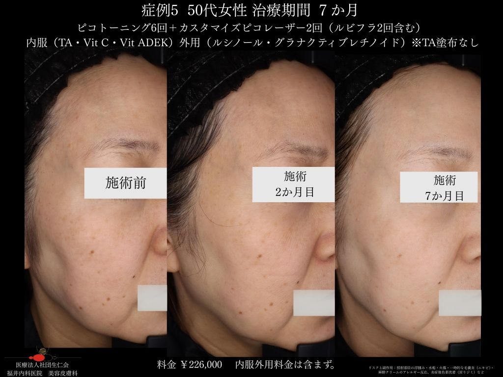 ピコレーザー症例_vol.5_007