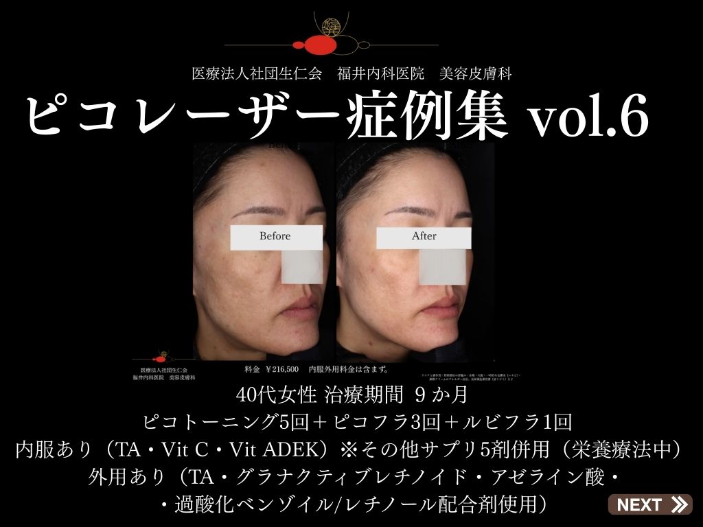 ピコレーザー症例_vol.6_001
