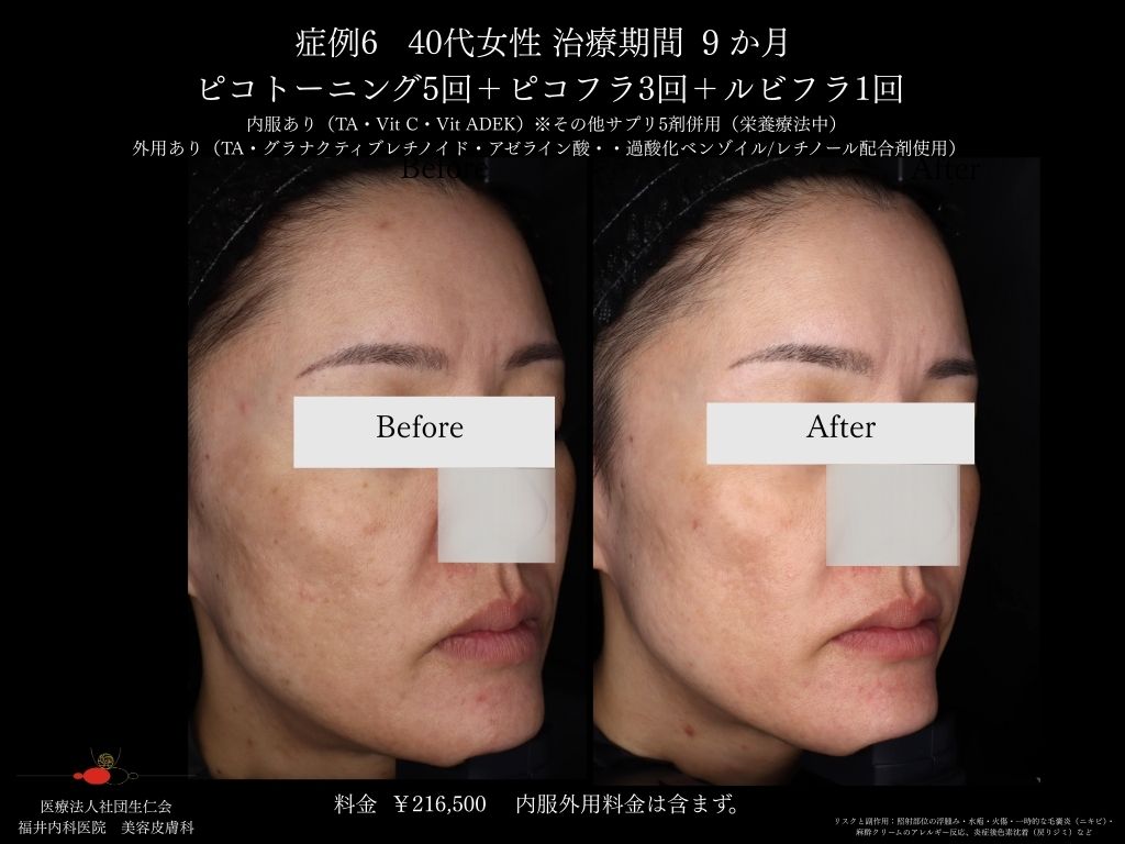 ピコレーザー症例_vol.6_002