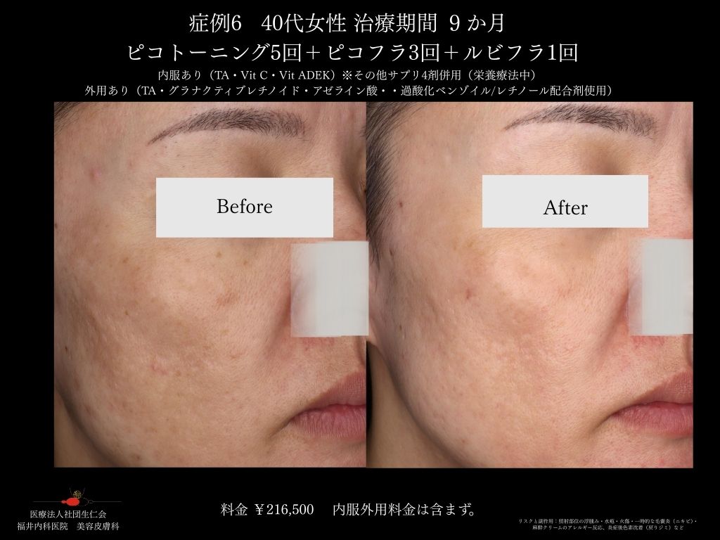 ピコレーザー症例_vol.6_003