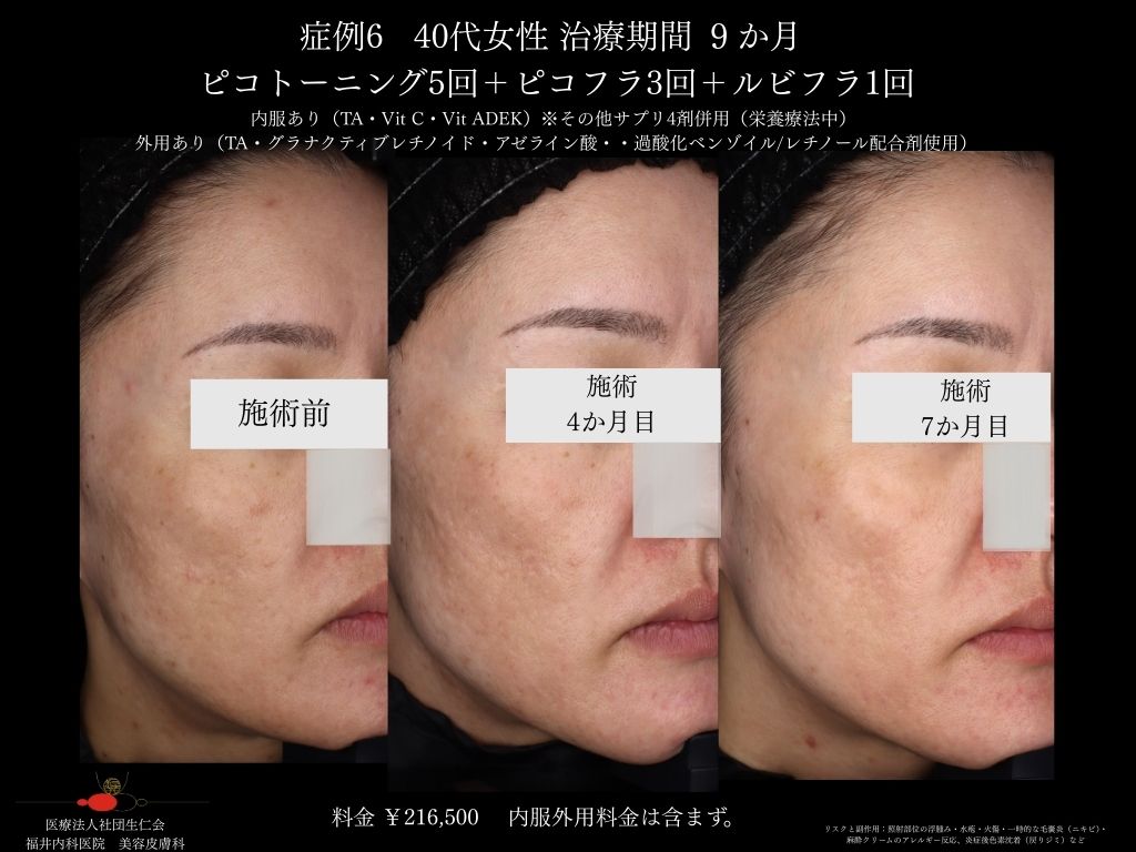 ピコレーザー症例_vol.6_004