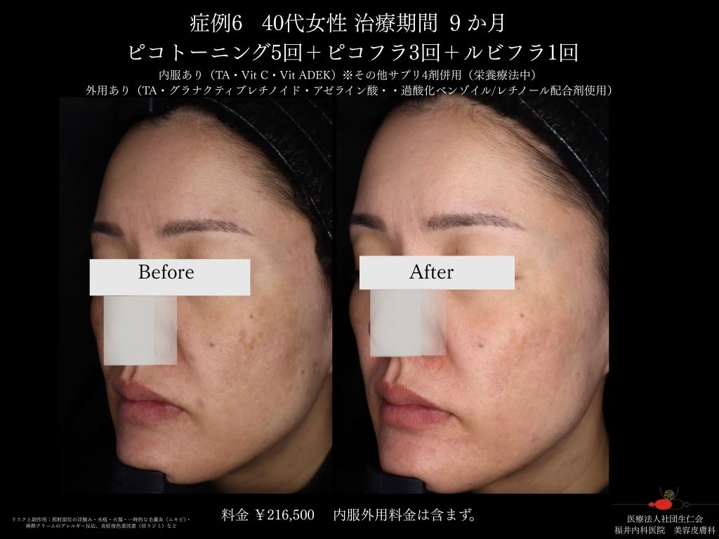 ピコレーザー症例_vol.6_005