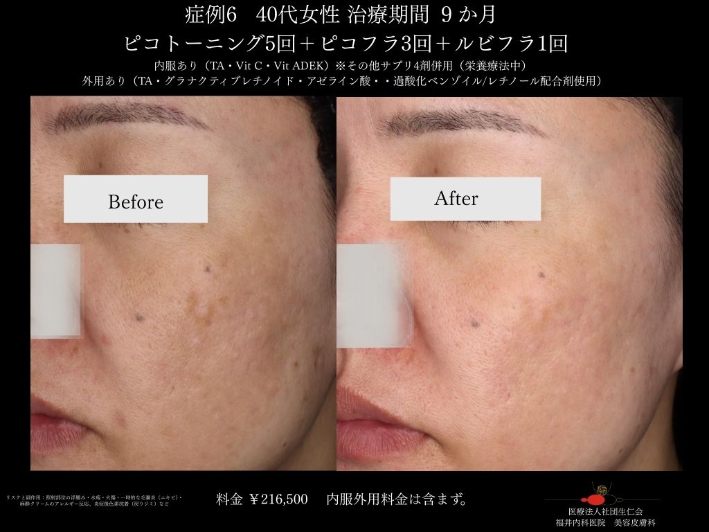 ピコレーザー症例_vol.6_006