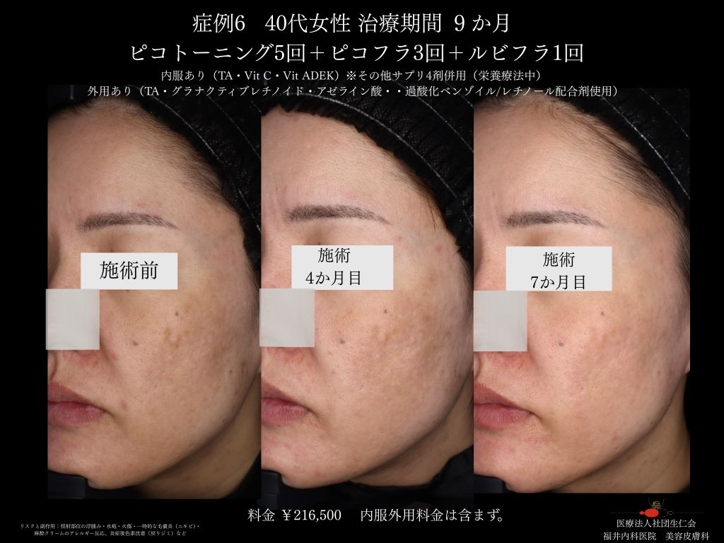 ピコレーザー症例_vol.6_007