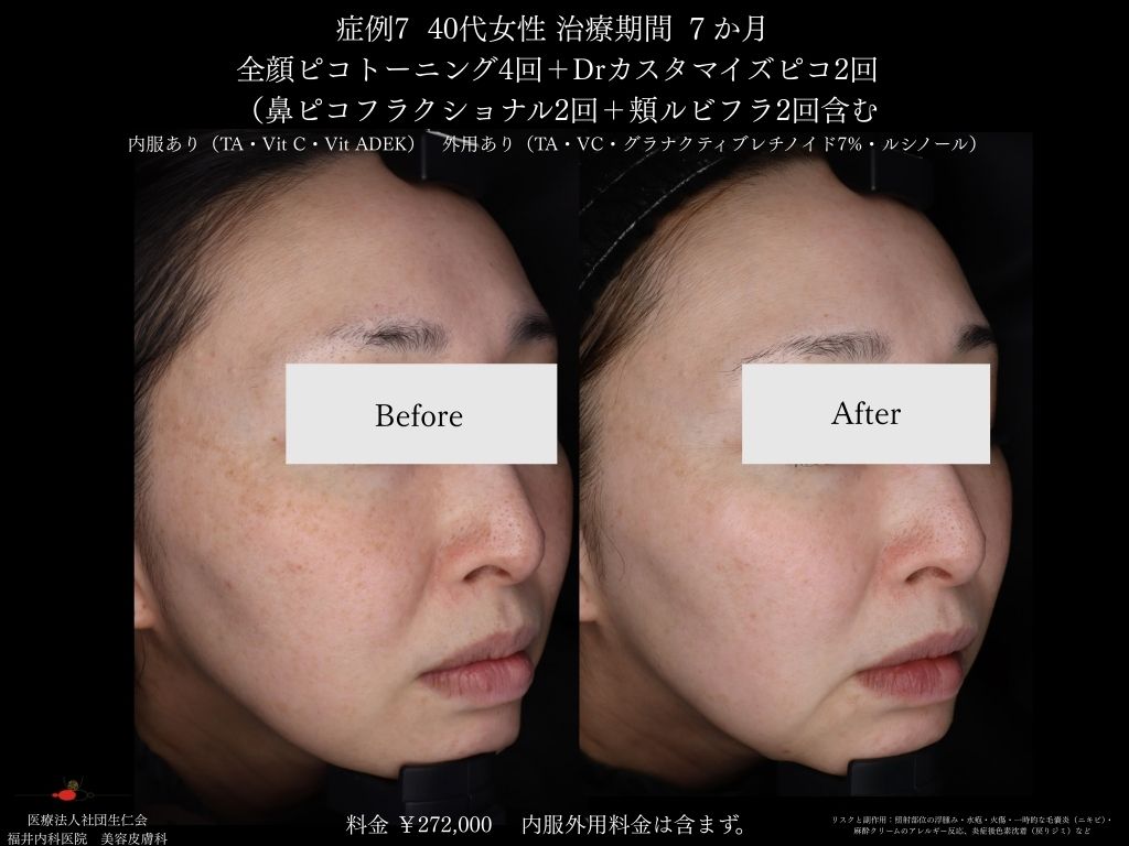 ピコレーザー症例_vol.7_002