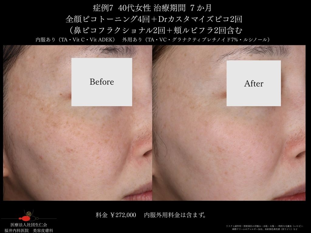 ピコレーザー症例_vol.7_003