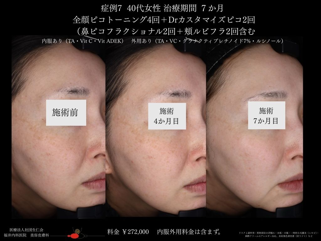 ピコレーザー症例_vol.7_004