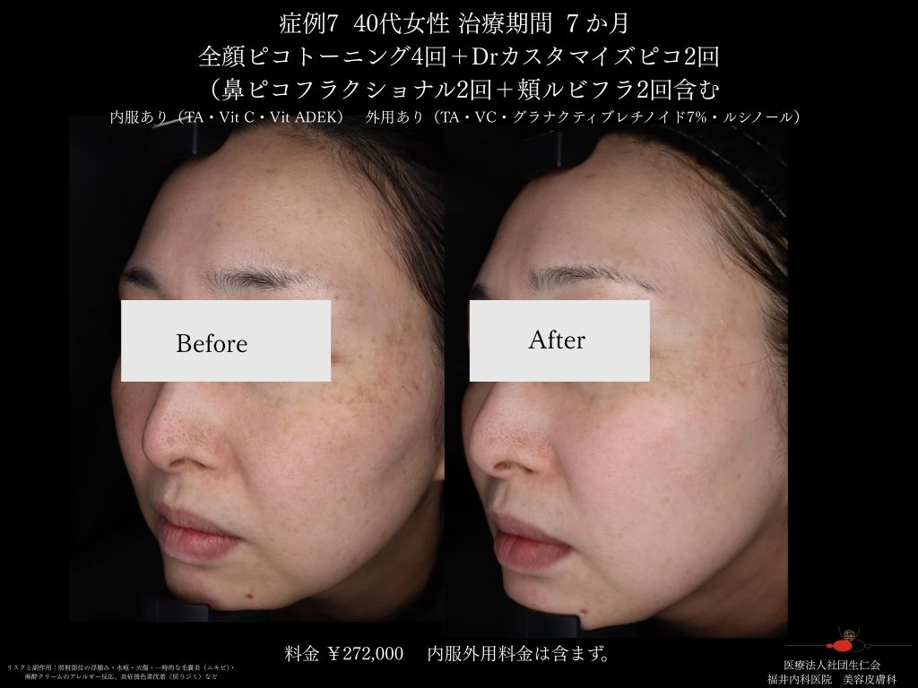 ピコレーザー症例_vol.7_005