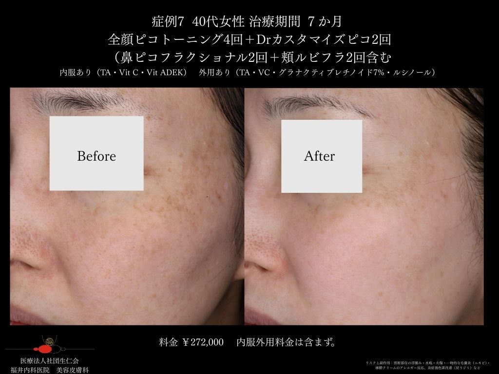 ピコレーザー症例_vol.7_006