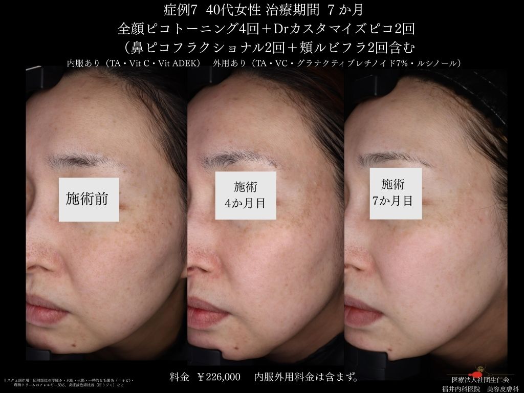 ピコレーザー症例_vol.7_007