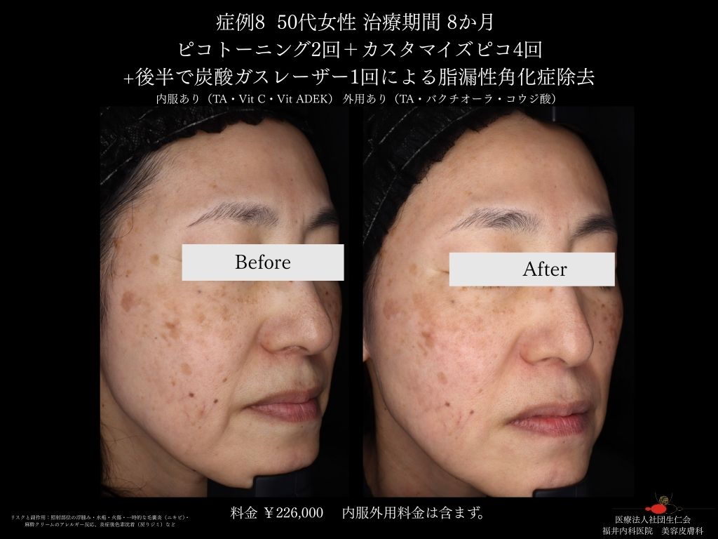 ピコレーザー症例_vol.8_002