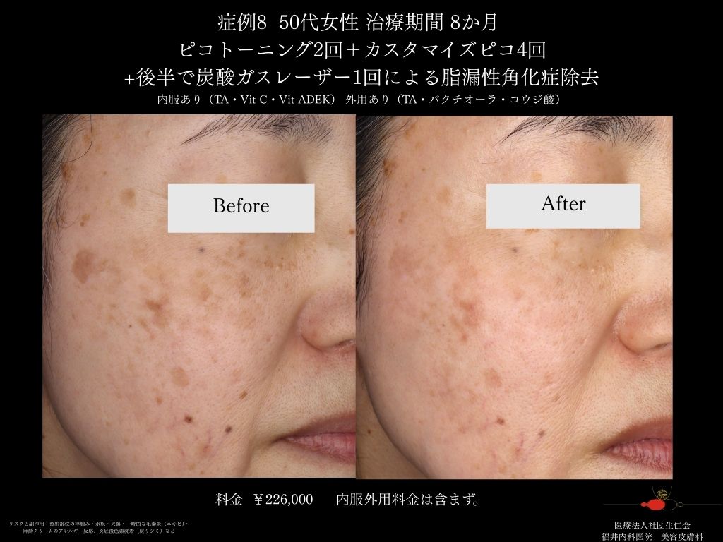 ピコレーザー症例_vol.8_003