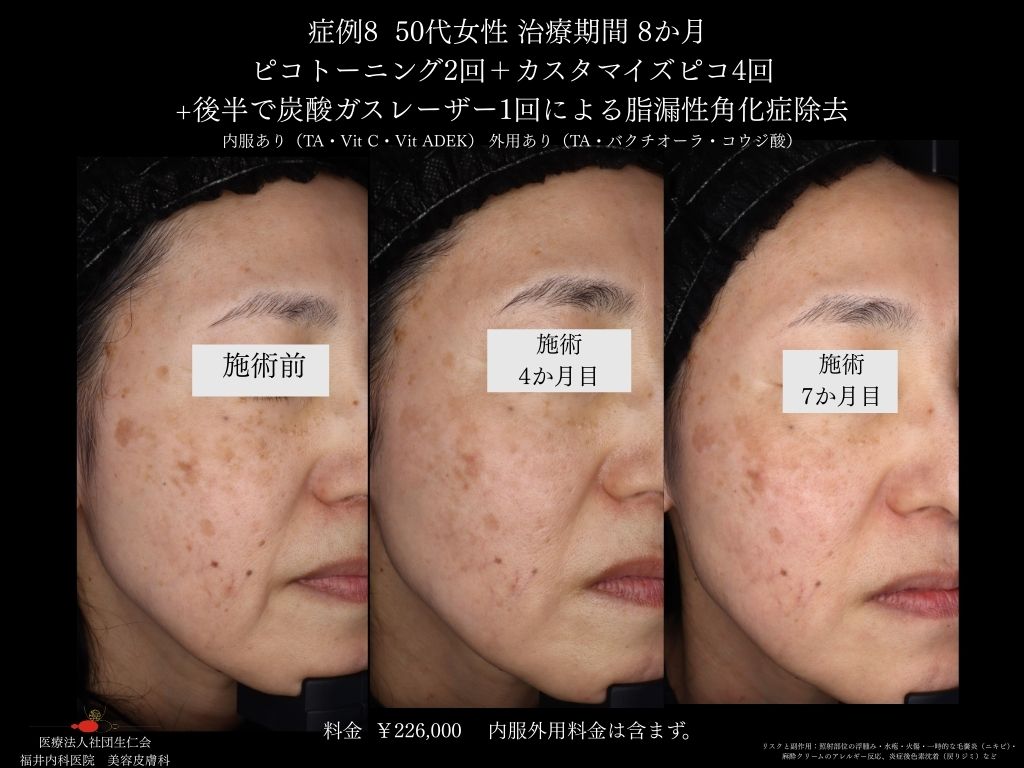 ピコレーザー症例_vol.8_004