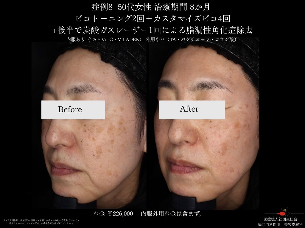 ピコレーザー症例_vol.8_005