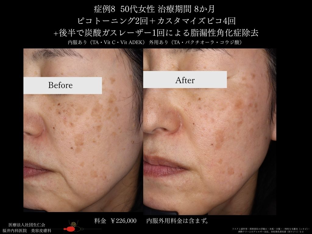 ピコレーザー症例_vol.8_006