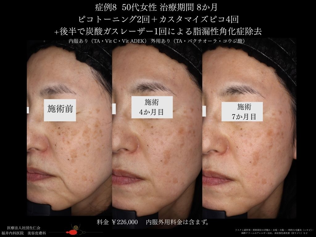 ピコレーザー症例_vol.8_007