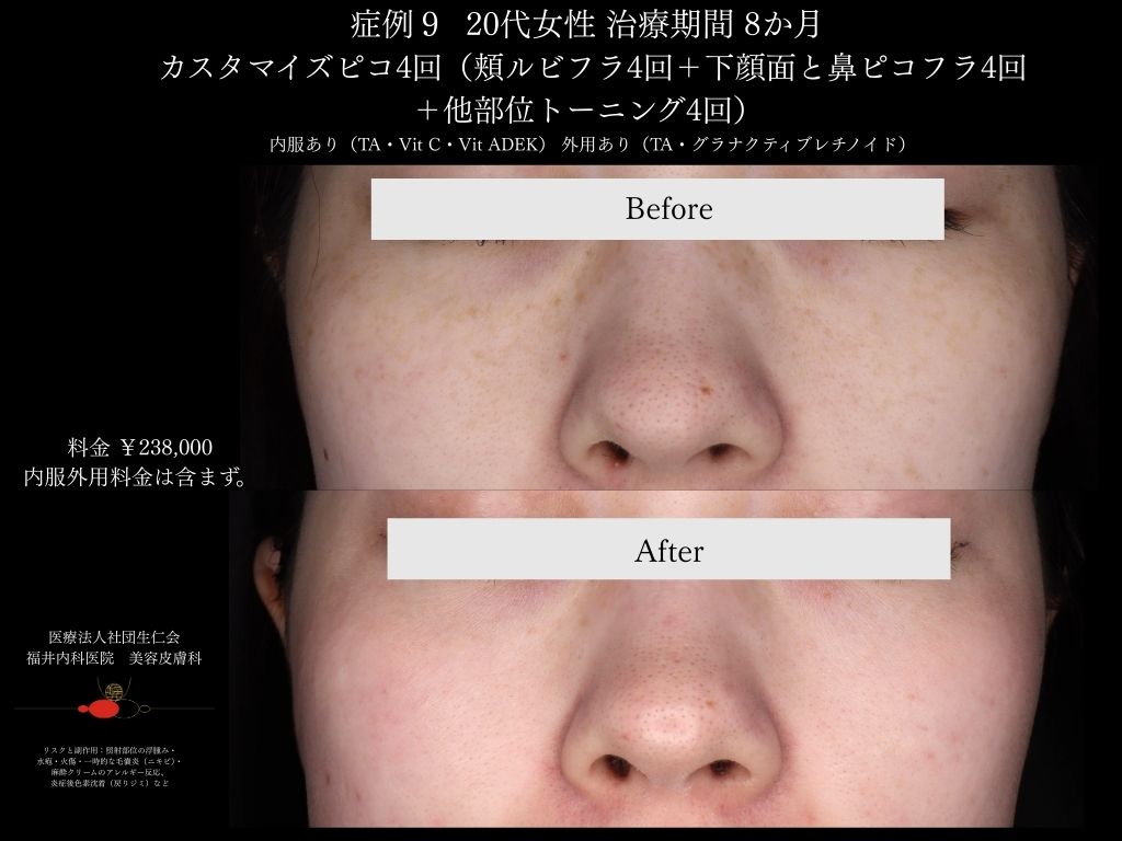 ピコレーザー症例_vol.9_002