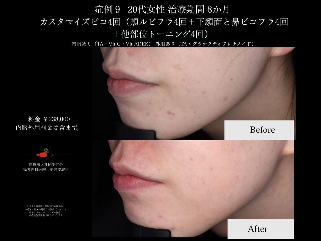 ピコレーザー症例_vol.9_003