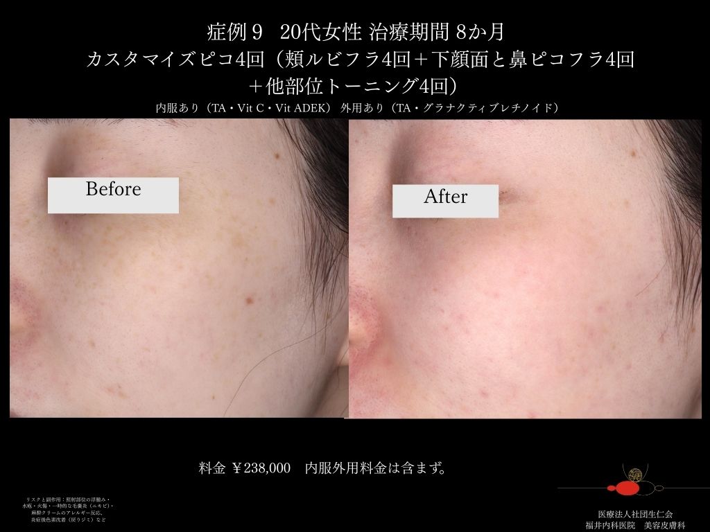 ピコレーザー症例_vol.9_004