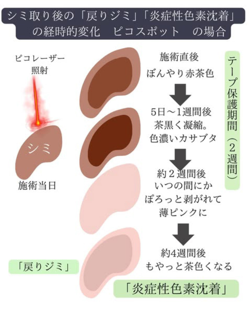 ディスカバリーピコレーザーの料金