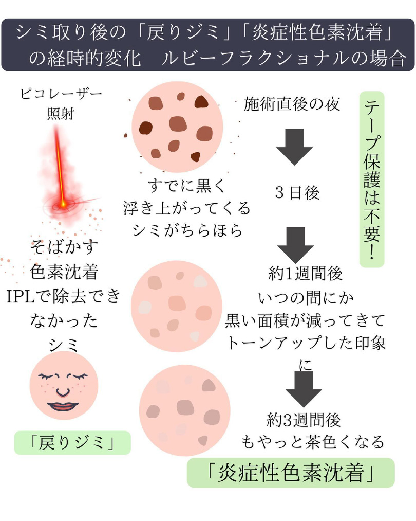 ディスカバリーピコレーザーの料金