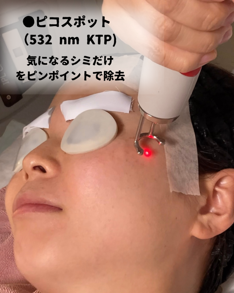 ディスカバリーピコレーザーの詳しい内容