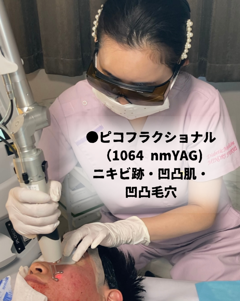 ディスカバリーピコレーザーの詳しい内容